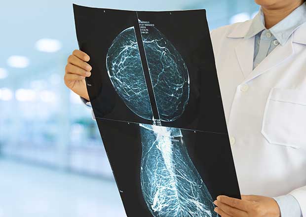 3D mammogram image